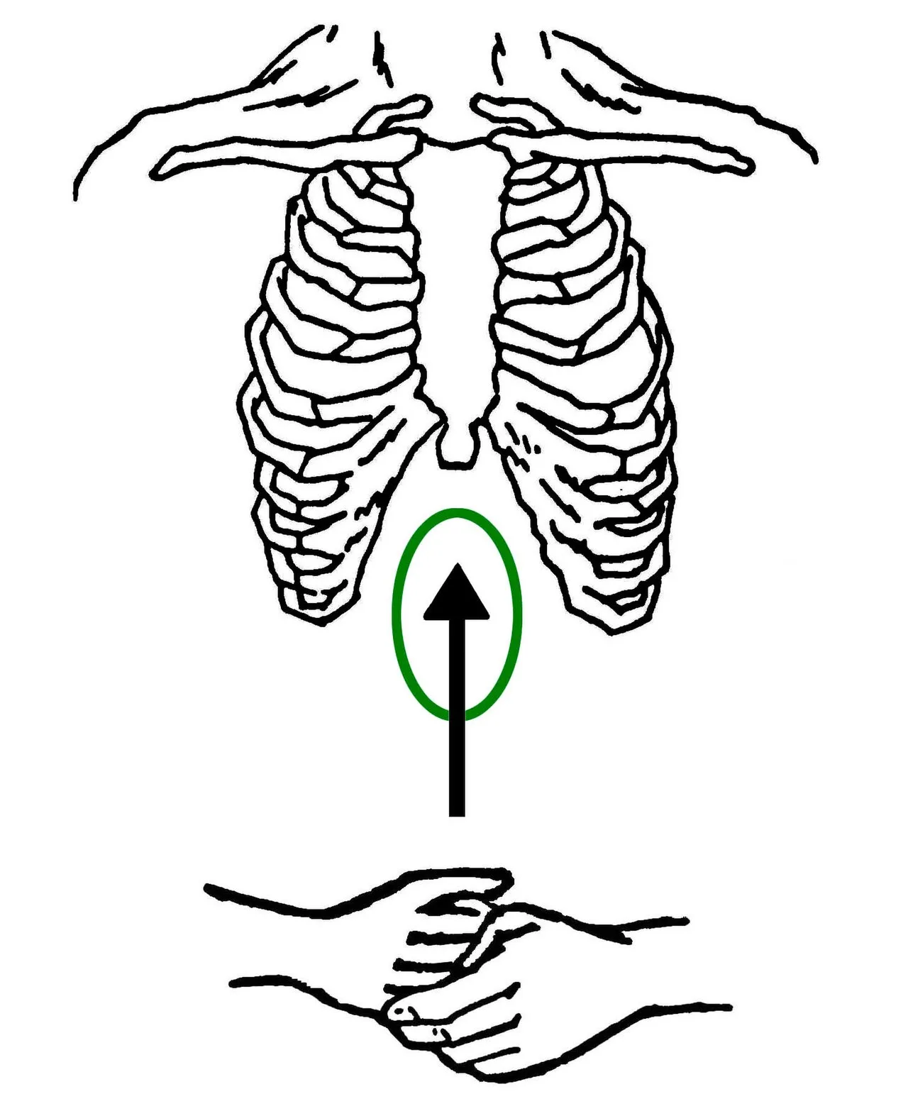 Point of application of abdominal thrusts (between chest and navel). The hands press inward and upward.