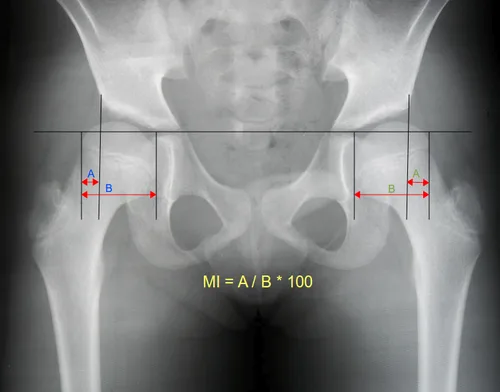 Reimer's migration index can be used to indicate hip dislocation. The migration index (MI) is normally less than 33%.[23]