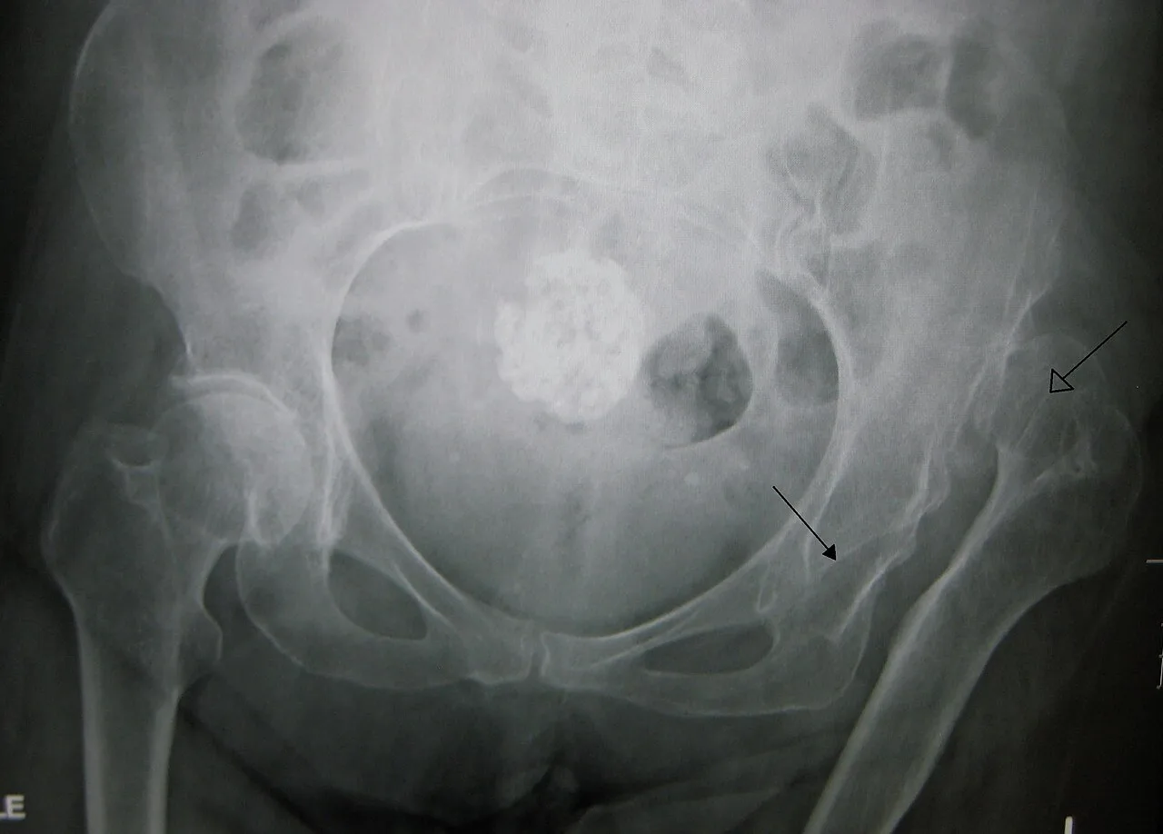 Dislocation of the left hip, secondary to developmental hip dysplasia. Closed arrow marks the acetabulum, open arrow the femoral head.