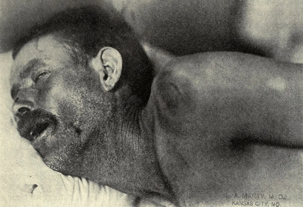 Neck stiffness, Texas meningitis epidemic of 1911–12