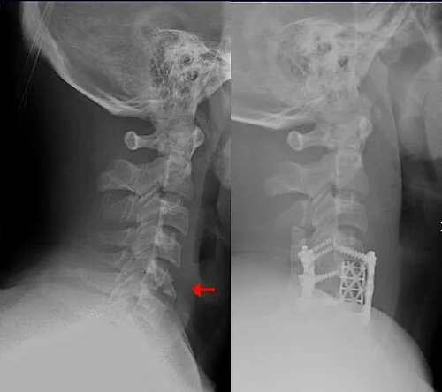 Teardrop fracture