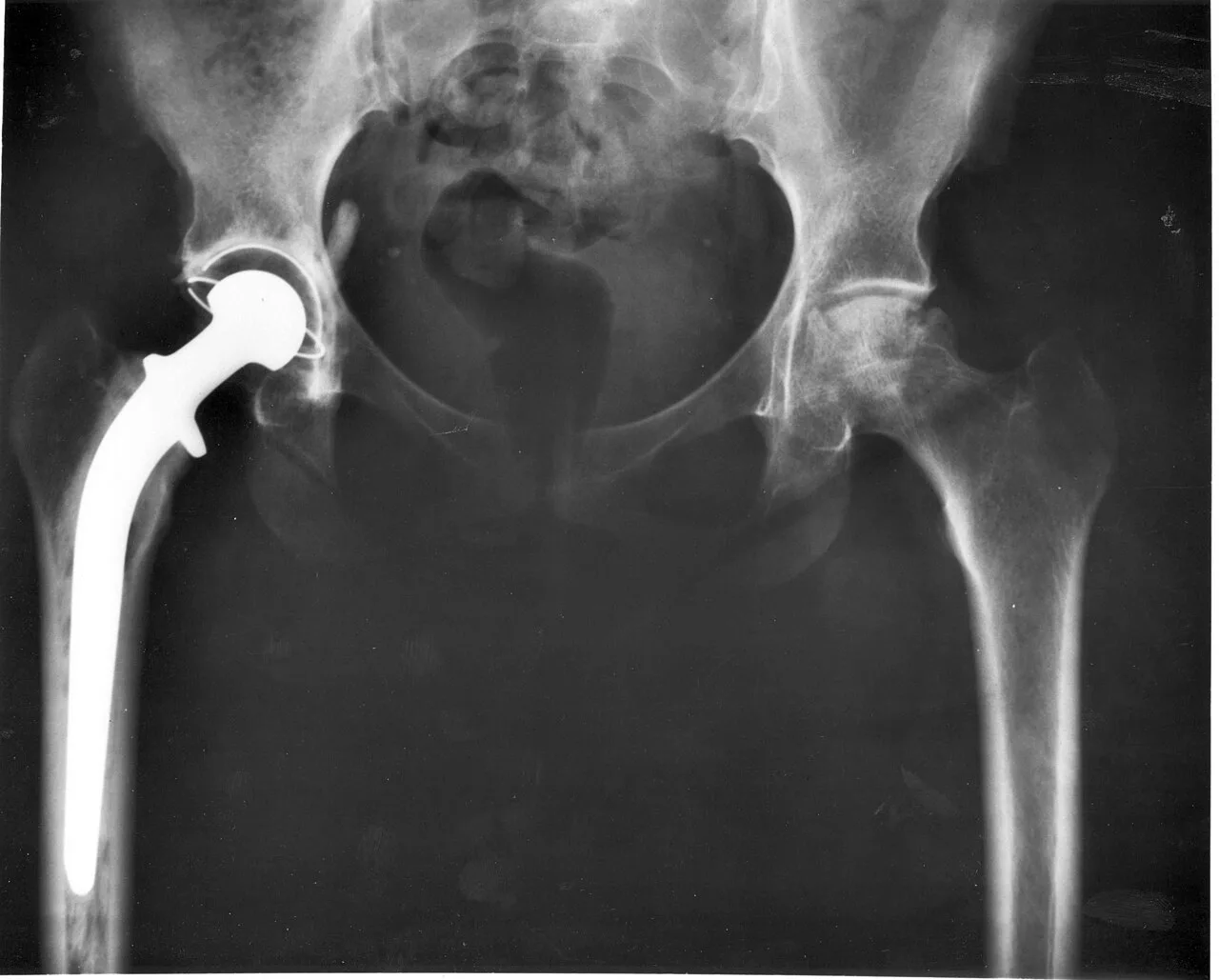 X-ray of a hip replacement